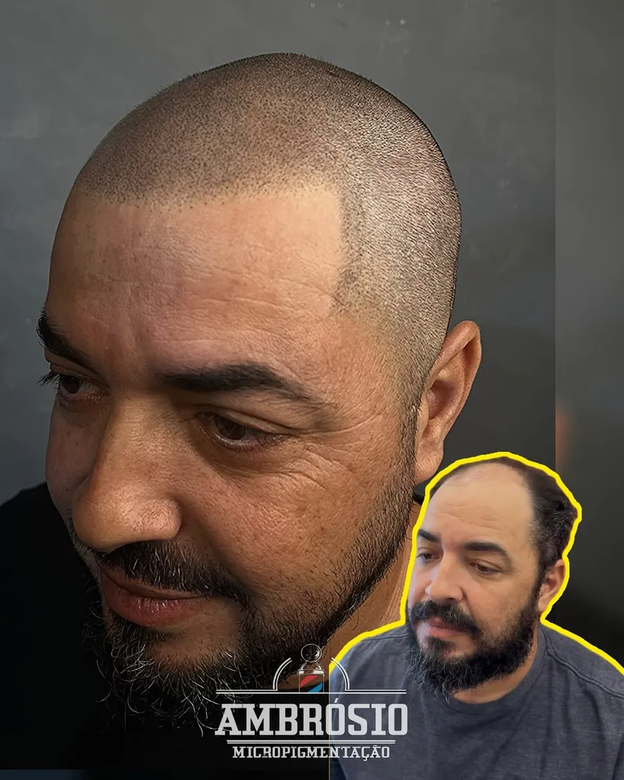 Antes e depois de micropigmentação capilar — vista de perfil