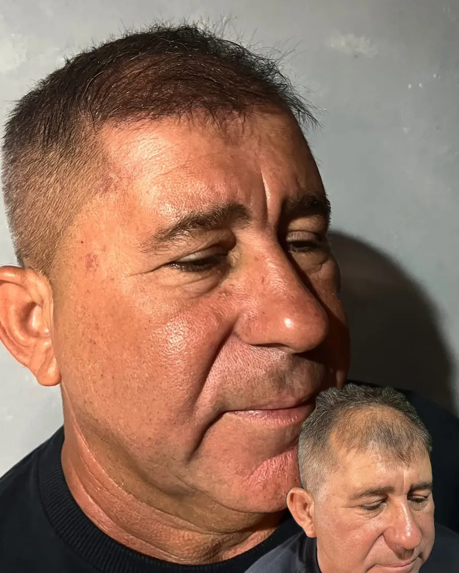 Antes e depois de micropigmentação capilar — resultado natural