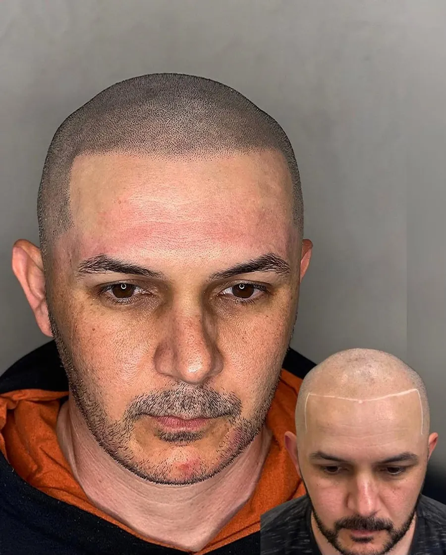 Antes e depois de micropigmentação capilar — vista frontal